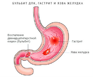 Эрозивный бульбит