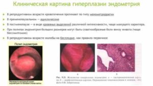 Гиперплазия эндометрия и циклодинон
