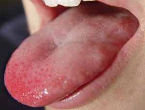 Дисбактериоз, обложен язык