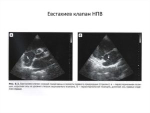 В полости ПП лоцируется подвижное линейное образование-удлиненный евстахиев клапан