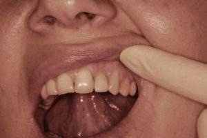 Болит нёбо после удаления зуба