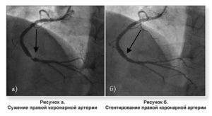 Результат коронарографии стентирование или АКШ