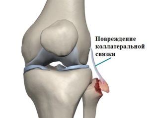 Дегенеративные изменения крестообразной связки