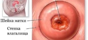 Образование на шейке матки ввиде прыщика