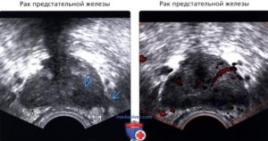 Гипоэхогенный узел простаты