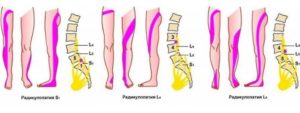 Межпозвоночная грыжа, боли в ноге