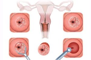 Месячные после конизации