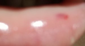 Красная точка на внутренней слизистой щеки