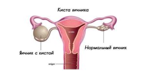 Киста яичника у подростка