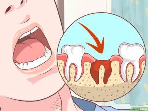 Болит нёбо после удаления зуба