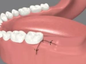Снятие швов после удаления ретирированного зуба, дырка в десне