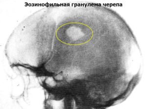 Эозинофильная гранулема костей черепа