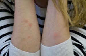Аллергия похожая на укусы