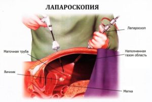 Боли после лапароскопии в правом боку