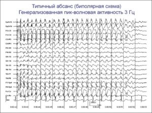 Эпи активность на ЭЭГ ребёнка 3 лет без приступов