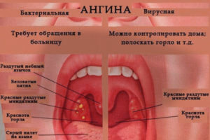 Болит горло и температура 39