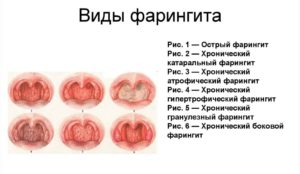 Оак на фоне хронического фарингита