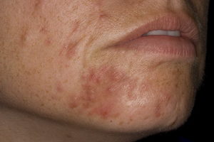 Ухудшение состояния кожи при лечении периорального дерматита