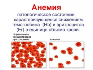 Гемолитическая болезнь новорожденных, низкий уровень гемоглобина и нейтрофилов в крови