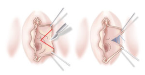 Малые половые губы