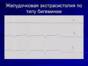 Частая желудочковая экстрасистолия по типу бигеминии