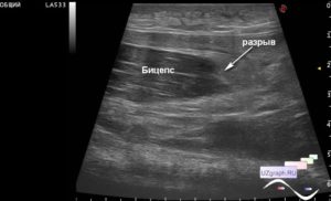 Образование на бицепсе, гематомы на УЗИ