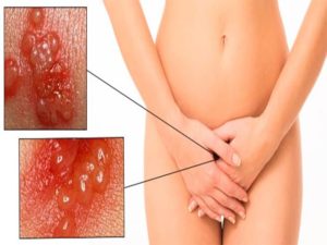 Зуд малых половых губ и входа во влагалище