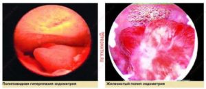 Что значит косвенные признаки железистого полипа