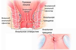 Анальная трещина у грудничка