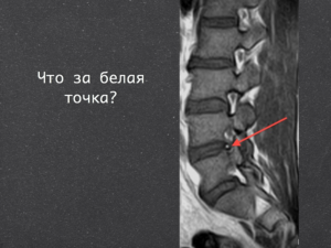 Белые пятна в позвонках на МРТ