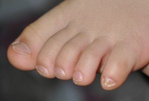 Мягкие и слоящиеся ногти на мизинцах ног