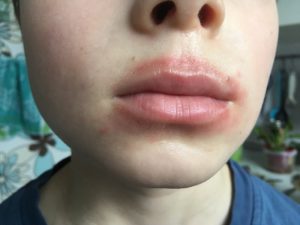 Обветренная кожа вокруг губ