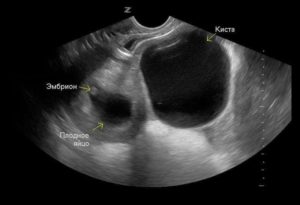 Киста левого яичника 6см