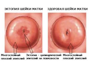 Что должно насторожить при прижигания очага эндометриоза и эрозии