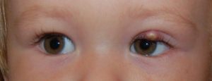 У ребенка щипят глаза