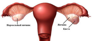 Боли в груди и киста левого яичника