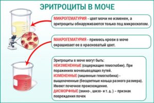 Гемоглобин и эритроциты в моче