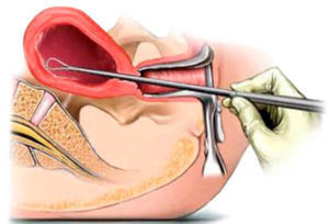 Чистка матки при маточном кровотечении
