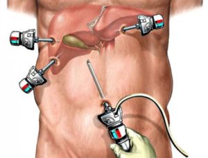 Боли после лапароскопии в правом боку