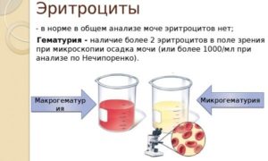 Эритроциты в моче от аллергии