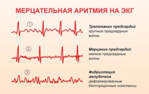 Мерцательная аритмия этацизин и предуктал