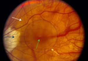 Центральная дистрофия сетчатки левого глаза у ребенка