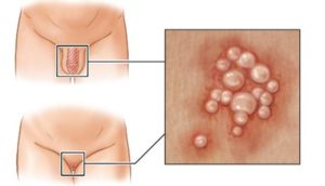 Секс при генитальном герпесе