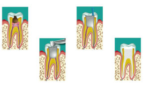 Непроходимость зубного канала