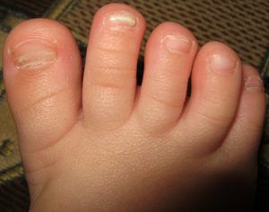 Мягкие и слоящиеся ногти на мизинцах ног