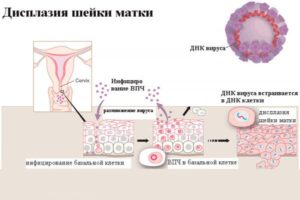 Может ли быть дисплазия 1степени без ВПЧ?