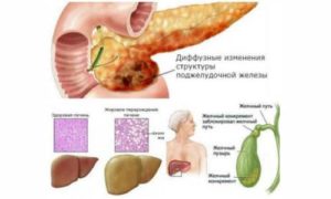 Хр. Холецистит. Диффузные изменения поджелудочной железы