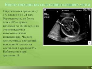 Киста сосудистого сплетения головного мозга