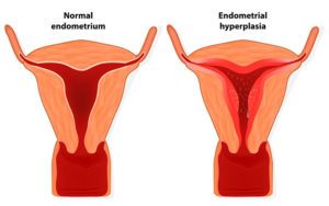 Задержка месячных, гиперплазия эндометрия