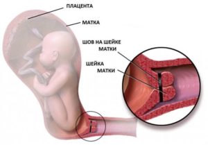 Короткая шейка на 27 неделе